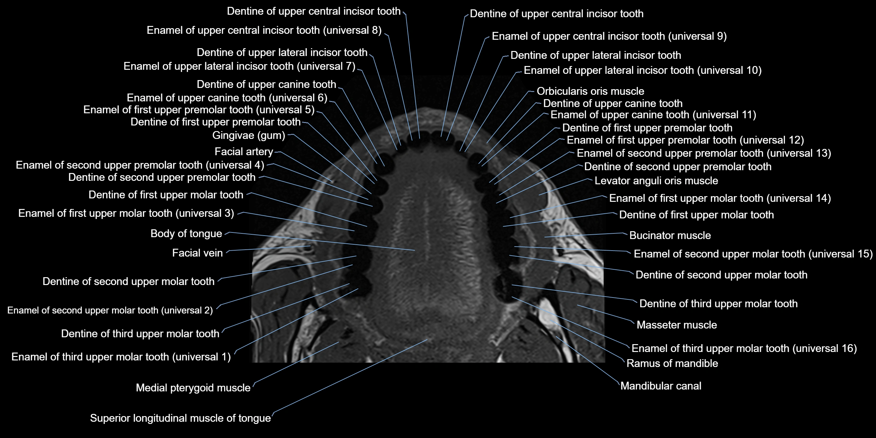 Dental MRI( tooth) axial labelled  cross sectional 3T anatomy -img-00008.webp